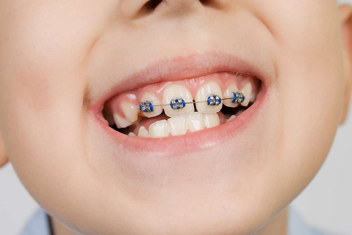 Orthodontie Enfant